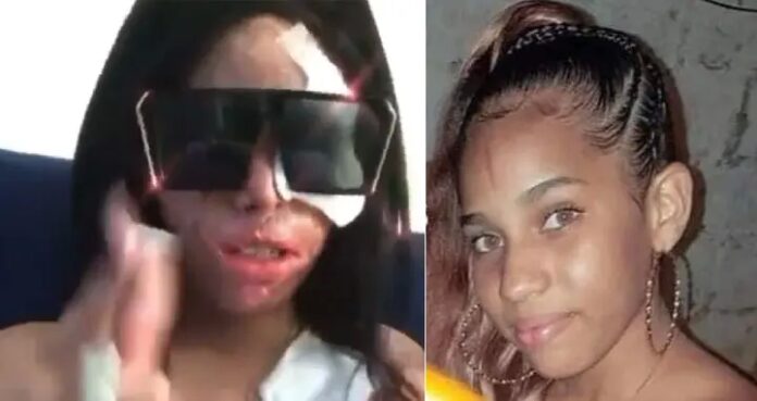 Tribunal dará fallo hoy en caso Yocauri Amarante, la joven rociada con ácido del diablo
