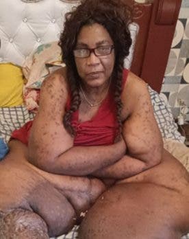 Exbaloncetista requiere solidaridad para seguir aportes