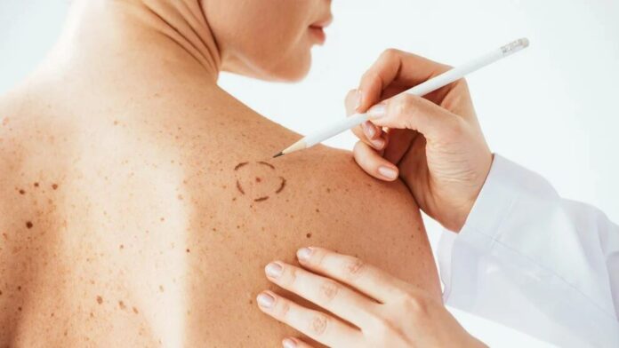 Alertan que trabajar en el sol causa una de cada tres muertes por carcinoma