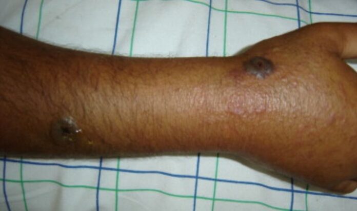 Las nuevas medidas de Haití tras confirmar una decena de casos de ántrax