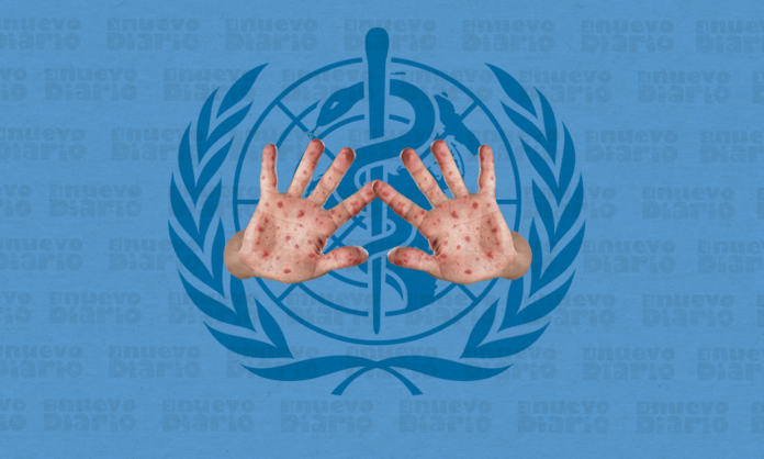 España vigila la nueva variante del mpox y recomienda vacuna