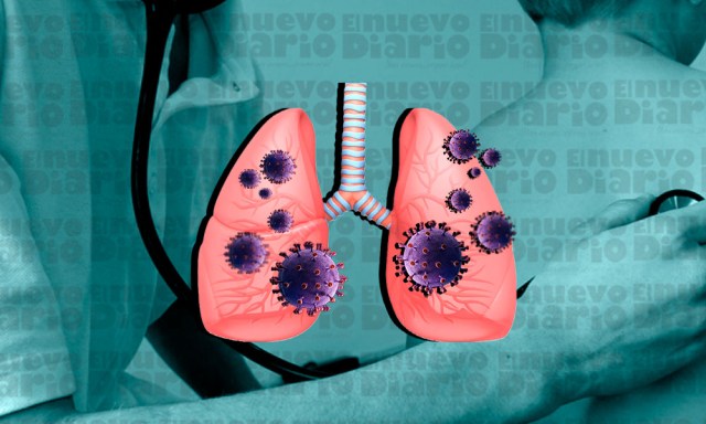 OMS registra por ano 450 casos de neumonia mundial la