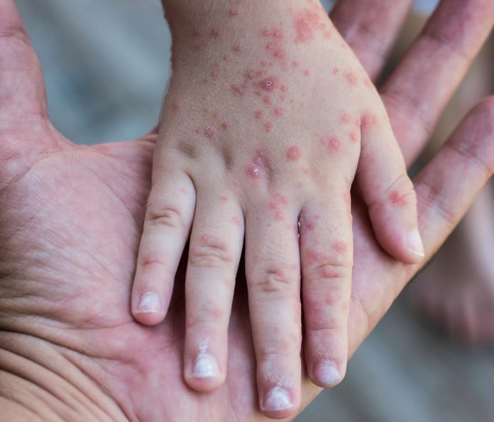 EEUU notificó a OMS brote de sarampión, cumpliendo Reglamento Sanitario