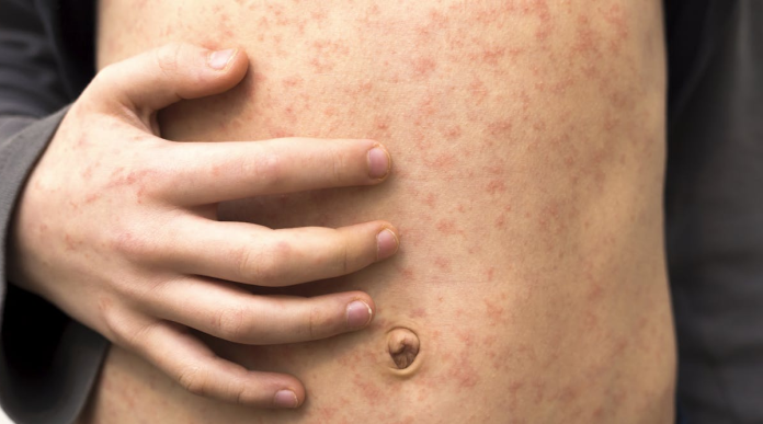 OMS y Unicef advierten que el sarampión en Europa está a su nivel máximo en 25 años