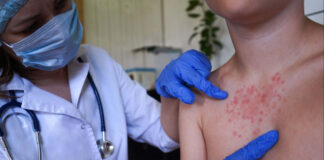 Sociedad Infectología alerta sobre riesgo de sarampión. Vigilancia en puertos y aeropuertos