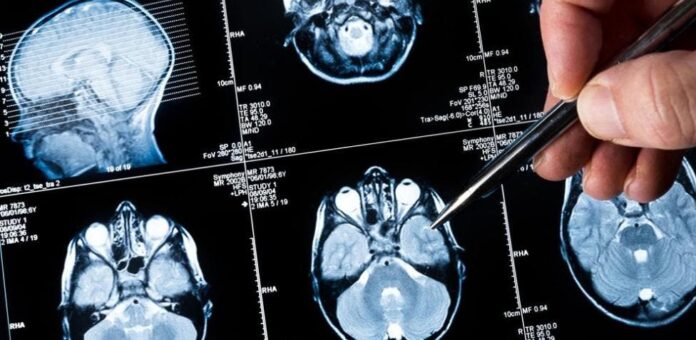 Nueva técnica permite extirpar tumor cerebro preservando un área del lenguaje