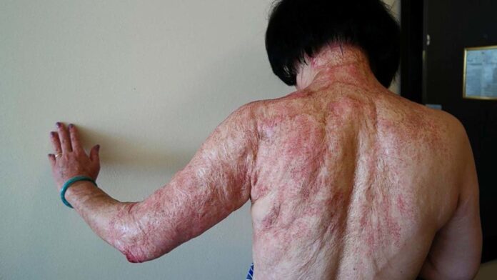 La “niña del napalm” de Vietnam culminó 50 años después un tratamiento para sanar su piel