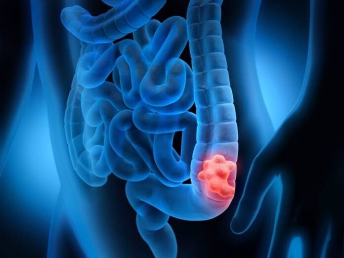 Identifican un nuevo gen clave para el crecimiento del cáncer de colon