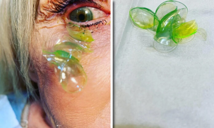 ¡Insólito! Oftalmóloga le retira 23 lentes de contacto a una mujer que olvidó retirarlos al dormir