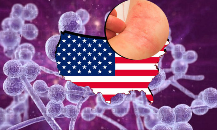 Aumentan los casos de infección con un hongo superresistente en EE.UU.
