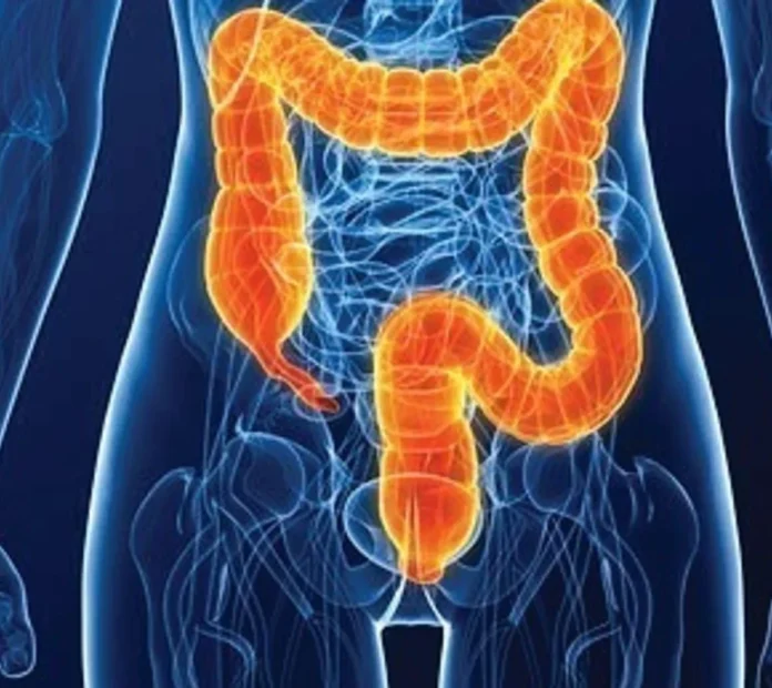 Cifras de cáncer de colon son “muy elevadas” en el país, según estudios