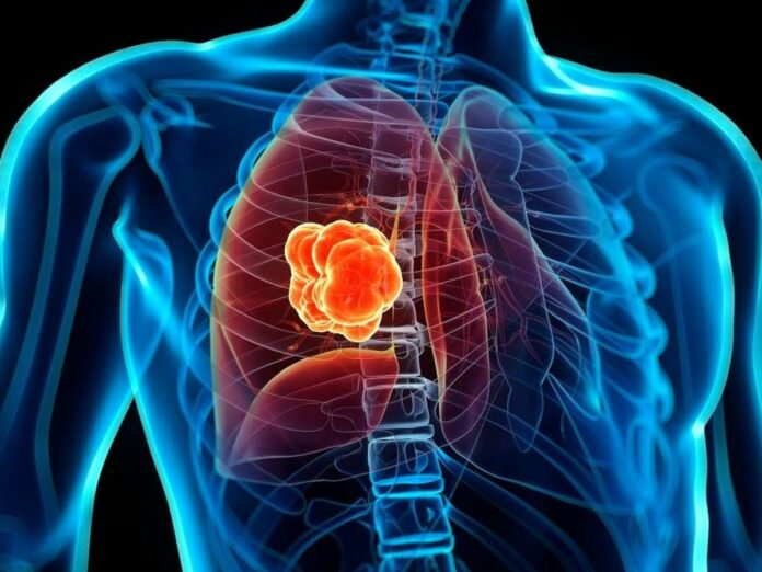 El cáncer de pulmón podría provocar la muerte de 160.000 latinoamericanos en una década