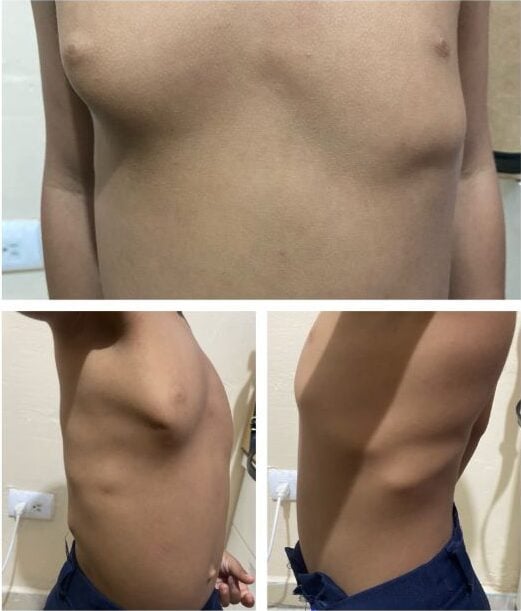 Reyniel Amparo tiene un sindrome que deforma su columna y