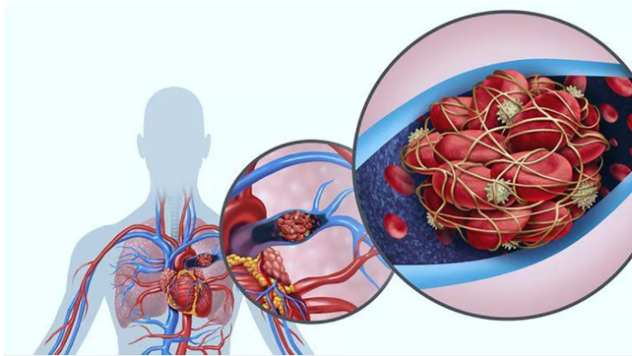 Forma de las venas pulmonares al llegar al corazón puede provocar mayor riesgo de trombos