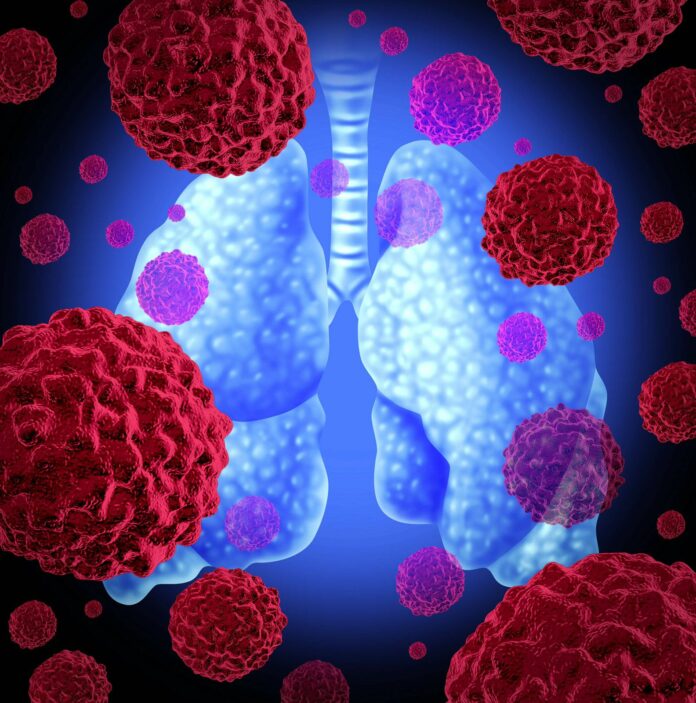 Pfizer dice uno de sus productos extiende la vida de pacientes con cáncer de pulmón