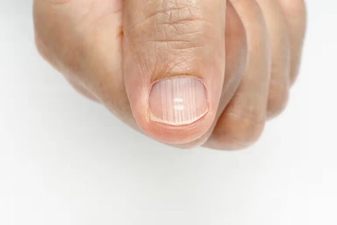 ¿Qué significa tener las uñas con rayas?