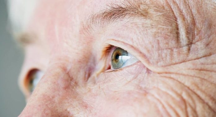 La progeria provoca envejecimiento prematuro./