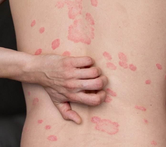 El impacto oculto de la psoriasis: más allá de una enfermedad en la piel