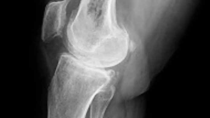 Científicos desvelan los factores que impulsan el osteosarcoma, un cáncer óseo agresivo