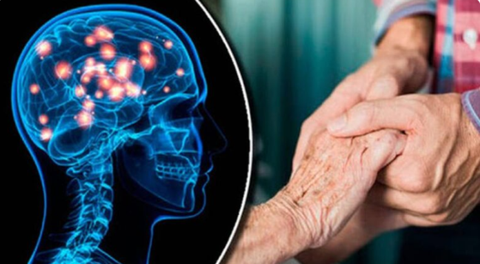 Huntington: una patología neurodegenerativa y hereditaria catalogada como «rara»