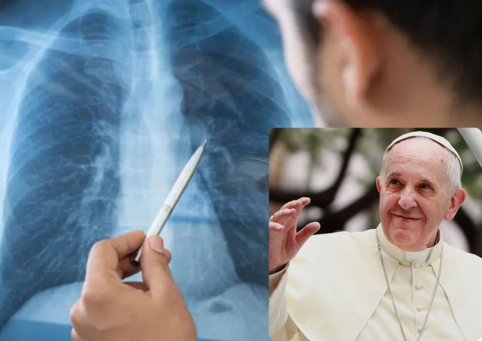¿Qué es la neumonía bilateral? La condición que sufre el papa Francisco